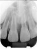 Fig 4. Preoperative radiograph showing aggressive external root resorption and thin dentinal walls.