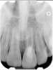 Fig 8. 3-year follow-up showing continued root development.