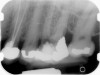 Fig 10. Preoperative radiographs showing mesial perforation.