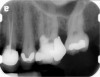 Fig 11. MTA perforation repair done, and calcium hydroxide medication placed in the canals.