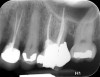 Fig 13. 2-year follow-up radiographs showing the positive outcome.