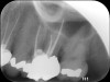 Fig 14. 2-year follow-up radiographs showing the positive outcome.