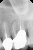 Fig 15. Preoperative radiograph.