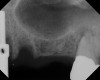 Fig 17. Case 2. Preoperative ridge in the No. 14 position. The height of native bone is about 4 mm to 5 mm.