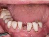 Fig 8. Mandibular restorations reveal decay; fractured teeth Nos. 20 and 24 are nonrestorable.
