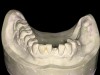 Fig 9. Mandibular definitive cast showing detail necessary for final prosthesis.