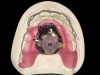 Fig 11. Maxillary acrylic appliance record base with striking plate mounted with an ink solution to identify centric relation or RCP.