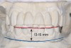 Fig 3. Desired changes in the incisal plane are marked on the diagnostic models.