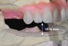 Fig 5. Bone reduction model surgery performed in mandibular arch to create 13 mm to 15 mm of inter-occlusal space required for the mandibular All-on-4 provisional restoration.