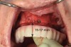 Fig 8. Provisional prosthesis guide is used as a surgical guide to verify adequate bone reduction and leveling with the incisal and occlusal planes of the prosthesis.