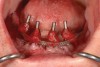 Fig 10. Surgical impression—Open-tray impression copings are secured and splinted with a denture-strengthening bar using low-expansion pattern resin.