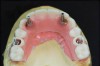 Fig 16. Indirect denture conversion—The indexed provisional prosthesis is modified for passive attachment of the posterior titanium cylinders to the prosthesis using heat-cured acrylic under pressure. This process is repeated for the anterior indexed implants, leading to a higher quality provisional with increased strength.