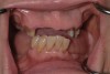 Fig 18. The patient’s intraoral condition.