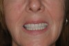 Fig 19. Patient smile shown 3 years post-treatment.