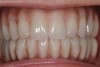 Fig 20. Patient intraoral condition 3 years following delivery of maxillary and mandibular All-on-4 definitive prosthesis.