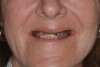 Fig 17. Pre-treatment smile of patient with terminal dentition.