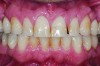 Fig 5. Preoperative view of patient requiring esthetic changes up to at least the bicuspids (Fig 5); postoperative view with CL-I feldspathic porcelain veneers up to the first bicuspid (Fig 6).