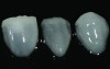 Fig 7. CL-IIa veneers with minimal incisal porcelain layering.