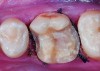 Fig 10. Preoperative view (Fig 9), preparation with composite block-out restoration (Fig 10), and final cementation of CL-IIb material (Fig 11) (final ceramic contour and stain by Steve Lee, CDT, MDC).