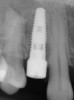 Fig 4. Flared abutments (healing or definitive) that encroach on the biologic width of the peri-implant bone will also result in apical remodeling. This is likely to compromise the critical crest of bone on the adjacent teeth that is largely responsible for supporting the papilla.