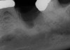 Fig 16. Radiograph of extraction socket. Buccal and lingual plates were defective.