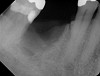 Fig 21. Radiograph of extraction socket. Buccal plate was two-thirds resorbed.
