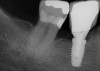 Fig 25. Radiograph showing appearance of restored implant after 1 year.