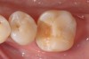 Fig 1. A mandibular first molar, with a fractured composite restoration: cavity preparation.