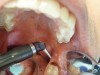 Fig 6. Excellent hemostasis after the completed ablation of the inflamed gingiva.