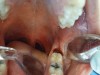 Fig 7. Immediate postoperative view. Additional tissue was ablated to make the ablated area blend with the surrounding tissue better. No suturing or dressing was required due to the hemostasis obtained with the CO2 laser.