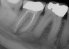 Fig 3. A patient presented with intense pain in tooth No. 31. A periapical radiograph demonstrated acute apical periodontitis. It was not possible to identify the extent of the periapical lesion with respect to the inferior alveolar canal.