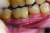 Fig 8. Case 1 clinical photograph of No. 19 after root canal treatment and crown fabrication.