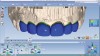 Fig 1. Whether in the dental office or the laboratory, CAD enables efficient and accurate design and evaluation of proposed restorations based on IOS data: multiple restorations can be done with CAD at one time (Fig 1), and individual cusps (Fig 2) can be manipulated and put in occlusion, as can contacts and restoration profiles (Fig 3).