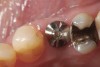 Fig 4. When surgical specialists use IOS following implant healing (Fig 4) with corresponding scanbodies (Fig 5), intraoral impression scans of the patient’s postoperative condition can be acquired and shared with the restorative dentist and laboratory (Fig 6).