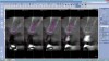 Fig 9. By merging CBCT files with IOS files and using implant planning software, dental professionals can plan all components of the implant/restoration procedure in advance for a restoratively driven approach: CBCT, IOS, and CAD merged and overlayed as one (Fig 9); implant placement and implant guide CAD (Fig 10).