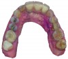 (1.) Optical scan of a maxillary arch (occlusal view). The impression provides details that allow the dentist to visualize composite and amalgam restorations, a fractured lingual cusp on the second maxillary left premolar, a metal ceramic crown on the maxillary right first molar, and an implant-supported anterior fixed dental prosthesis.