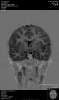 Fig 2. This MRI shows the neostriatum in the brain of a child (arrows: striatum).