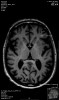 Fig 3. Gross atrophy of the caudate nucleus and putamen occurs within the neostriatum in Huntington’s disease (top arrow: head of caudate nucleus; bottom arrow: putamen).