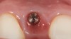 Fig 5. A surgical cover screw was placed onto the implant in order to achieve gingival augmentation in situ prior to a secondary soft-tissue procedure.