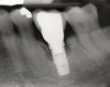 Fig 17. Radiograph showed symmetrical infrabony defect affecting 50% of the implant surface.