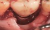 Fig 19. The circumferential defect was debrided. Note excess cement extending apically from the margin of the crown into the defect; residual cement has been shown to be complicit in the development of peri-implant disease.