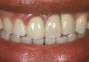Fig 29. Two adjacent implants placed in the esthetic zone can lead to loss of the interdental papilla and a negative outcome for a patient with a high smile line.