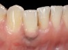 Fig 32. A dissatisfied patient presented with significant midfacial recession of implant restoration of tooth No. 26. Pink ceramic material was used unsuccessfully to prosthodontically compensate for the lost midfacial tissue.