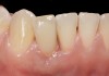 Fig 45. The definitive crown tooth No. 26 seated in place and provisionally cemented. The recession defect was eliminated with the removal and replacement of a new implant in the proper position.