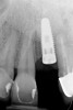 Fig 48. Radiograph of implant in the area of tooth No. 9 in Figure 47. Note the close proximity of the implant No. 9 to tooth No. 10.