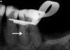 Fig 4. Radiographic example of a separated endodontic rotary NiTi file.