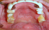 Fig 2. Pseudomembranous candidiasis in a patient with xerostomia.