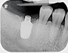 Fig 6. Radiograph following crown fracture.