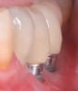 Fig 6. From a more anterior view, it was apparent that the labial positioning of these implants was outside the alveolar housing.