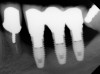 Fig 7. Radiographic image of the area suggesting severe bone loss around the dental implants.